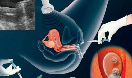 試管嬰兒技術卵胞漿內單精子注射是什么意思